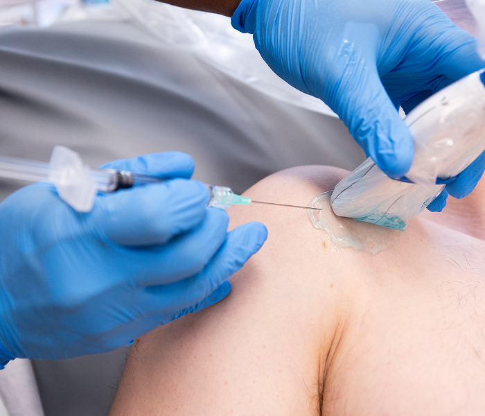 Ultrasound guided steroid injection for shoulder pain