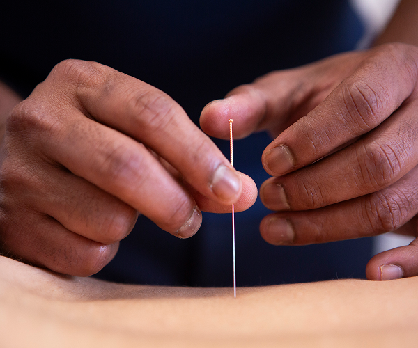 Acupuncture treatment to reduce pain and inflammation in Chester